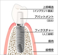 インプラント