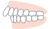 上顎前突（出っ歯）