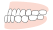 下顎前突（受け口・反対咬合）